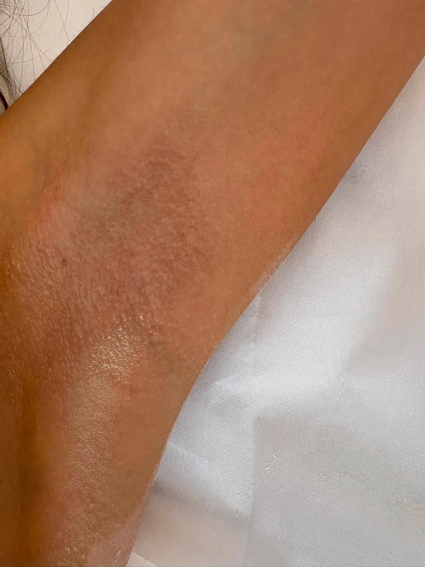 Underarms, after